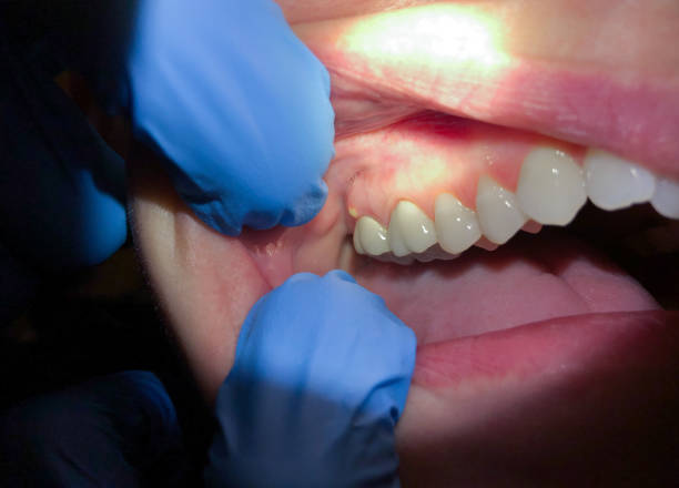 Best Emergency Tooth Extraction in University Of Pittsburgh Johnstown, PA