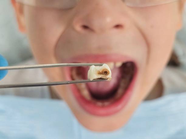 Best Emergency Wisdom Teeth Removal in University Of Pittsburgh Johnstown, PA